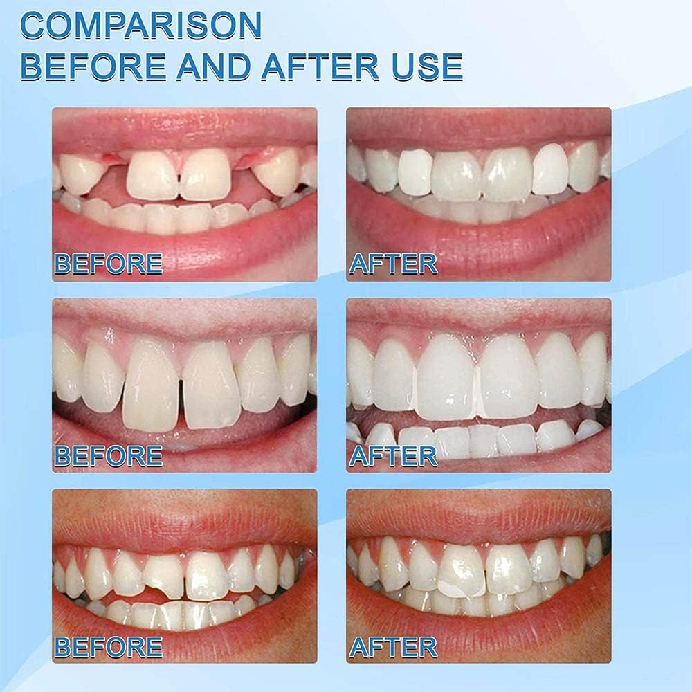 Moldable Temporary Tooth Repair Gel for Filling Gaps