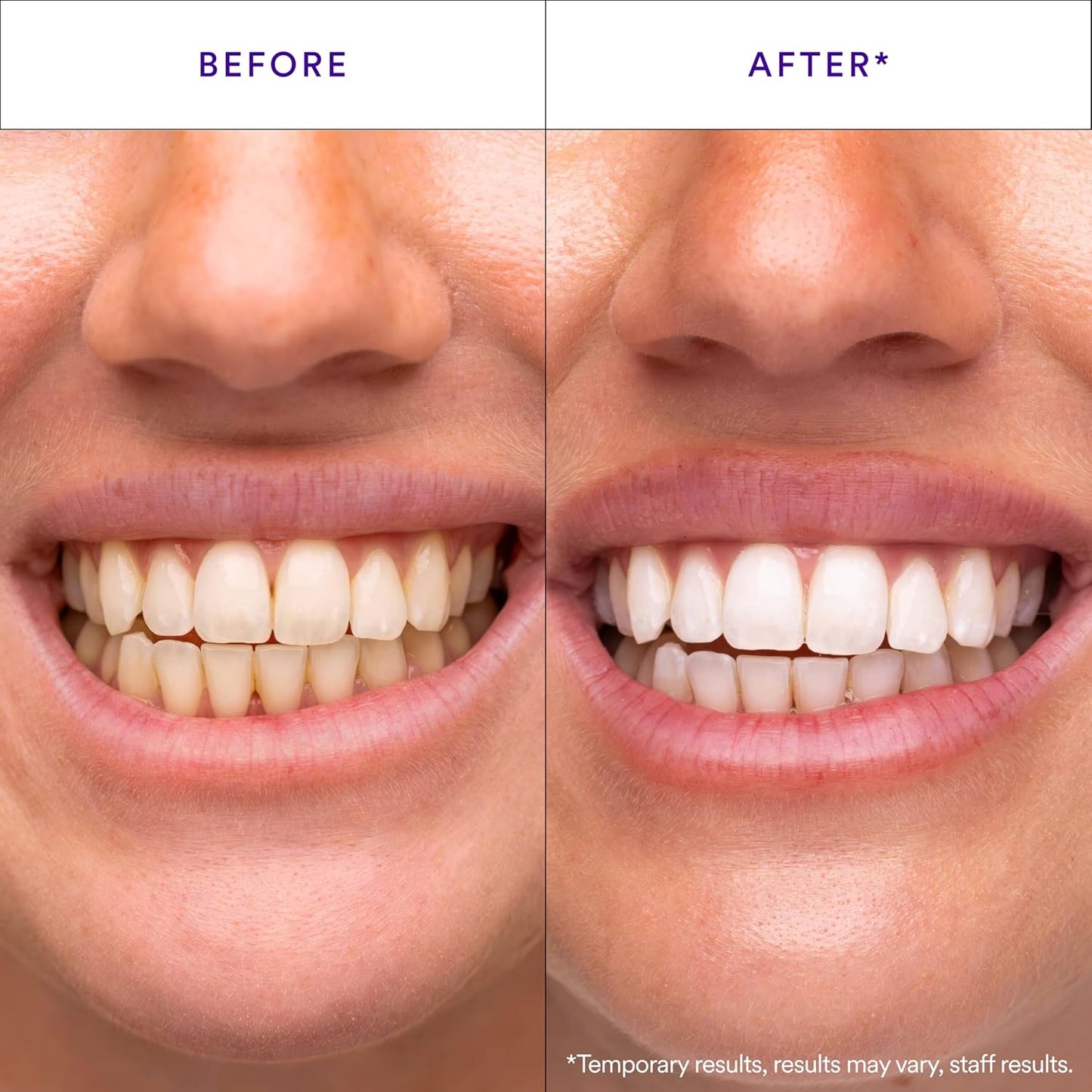 Purple V34 Teeth Whitening Strips - Tooth Stain Treatment, Combining Whitening and Colour Correction