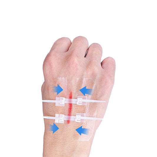 Non-Invasive Surgical Zip Stitches: Medical Grade Wound Closure Device