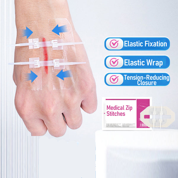 Non-Invasive Surgical Zip Stitches: Medical Grade Wound Closure Device