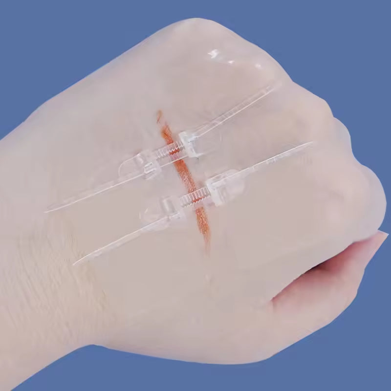 Non-Invasive Surgical Zip Stitches: Medical Grade Wound Closure Device