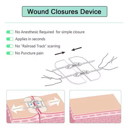Non-Invasive Surgical Zip Stitches: Medical Grade Wound Closure Device