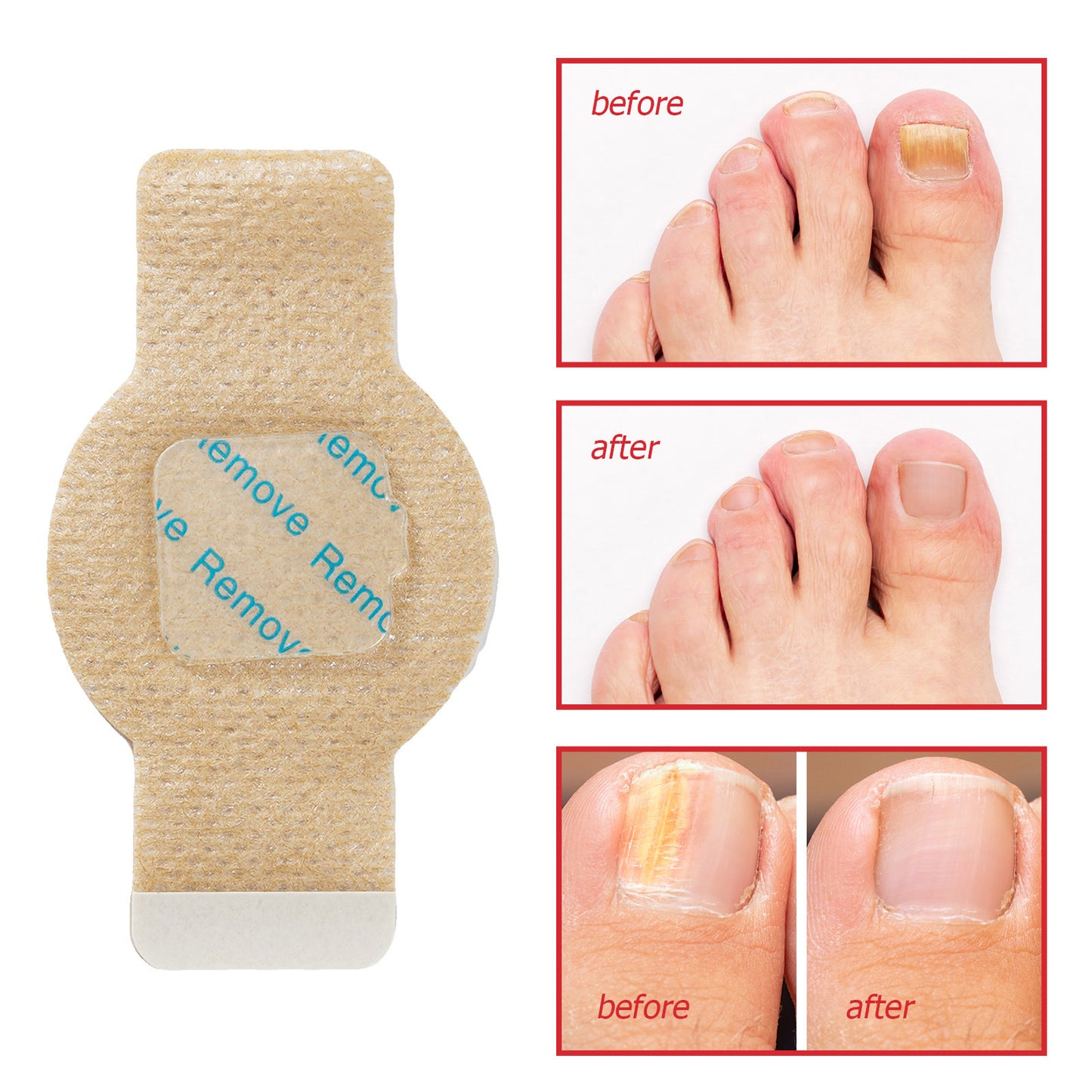 21Pcs Fungal Nail Patches: Extra Strength Treatment to Restore Healthy-Looking Nails