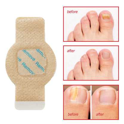 21Pcs Fungal Nail Patches: Extra Strength Treatment to Restore Healthy-Looking Nails