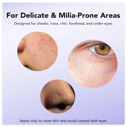 MILIA REMOVER 30 mL Milia Remover Treatment